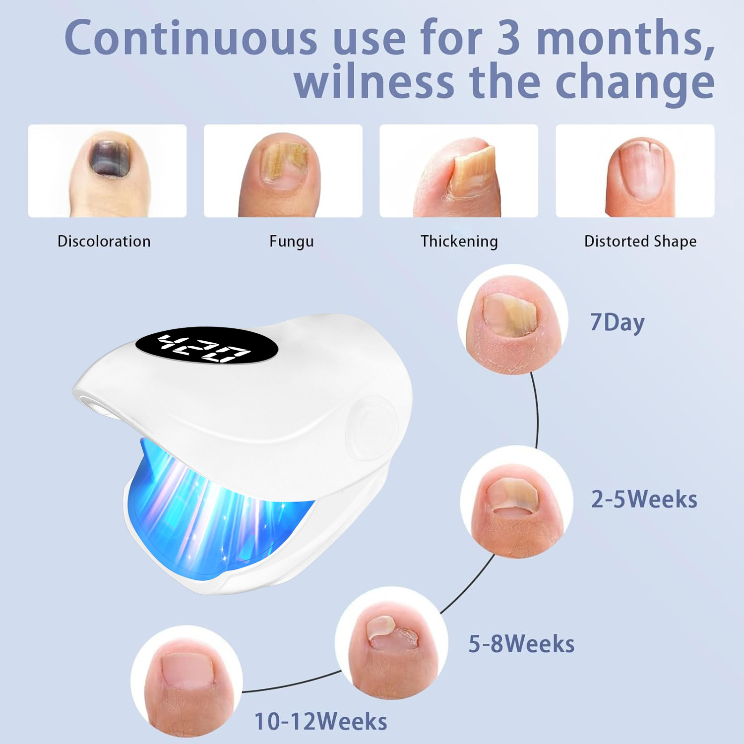 USB Charging Nail Fungus Treat - đánh giá và giá Galvanic Skin Sensor